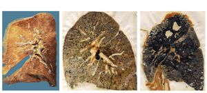 Photograph of a lung that healthy (left), with simple black lung disease (center), and complicated black lung disease (right).